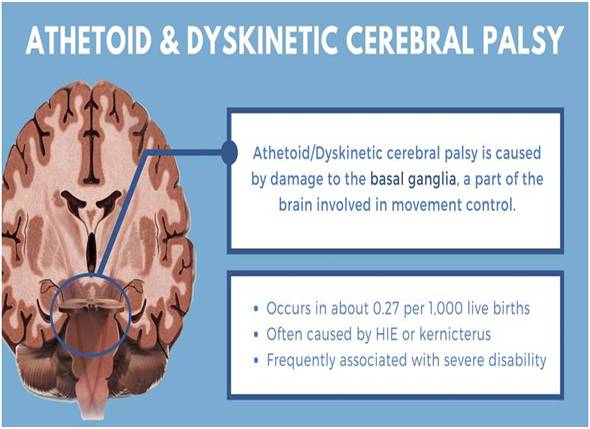 Athetoid Cerebral Palsy